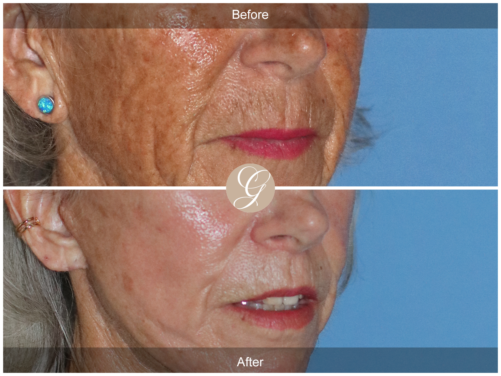 Lip Lift 0883 Image
