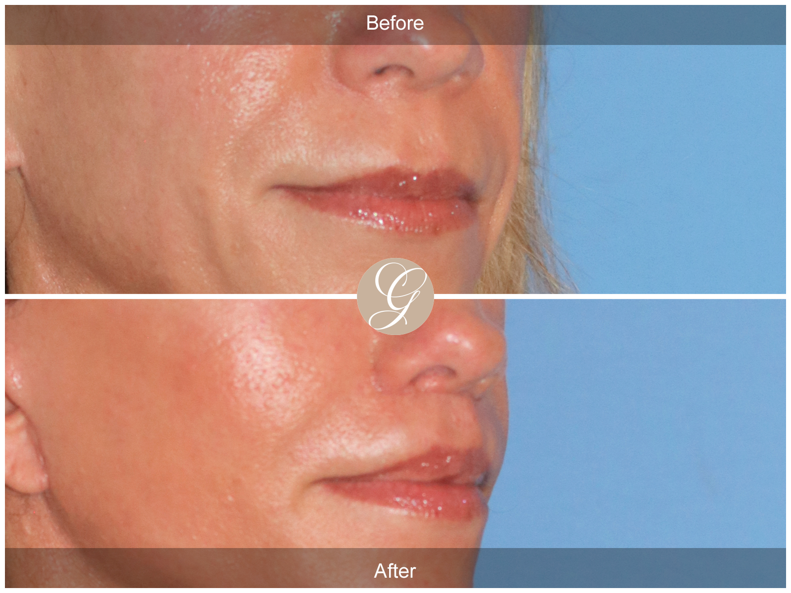 Lip Lift 9245 Image