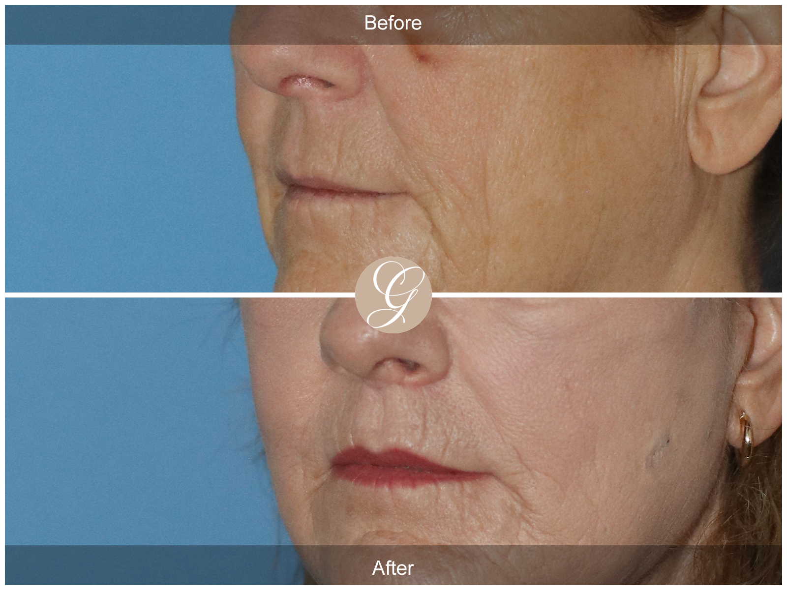 Lip Lift 0764 Image