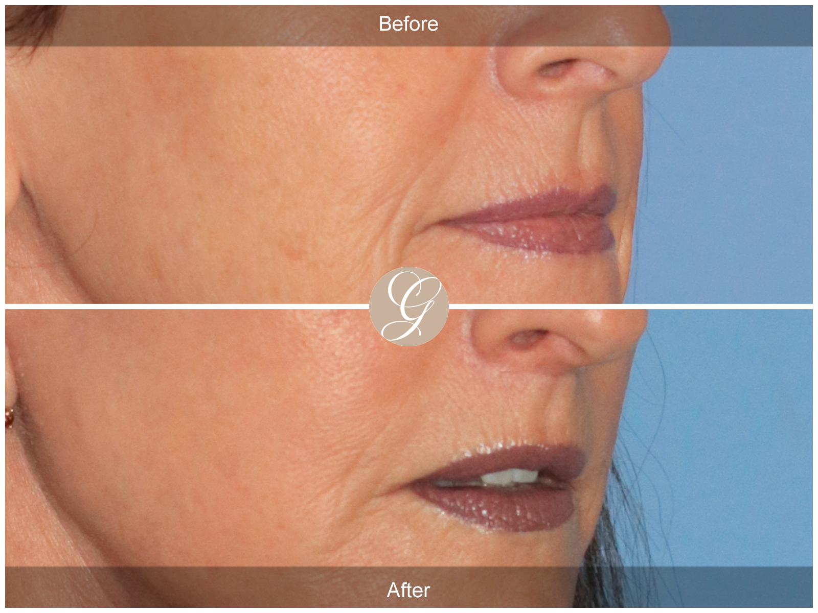 Lip Lift 0822 Image
