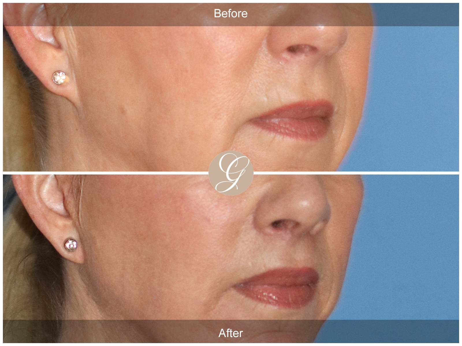 Lip Lift 0994 Image