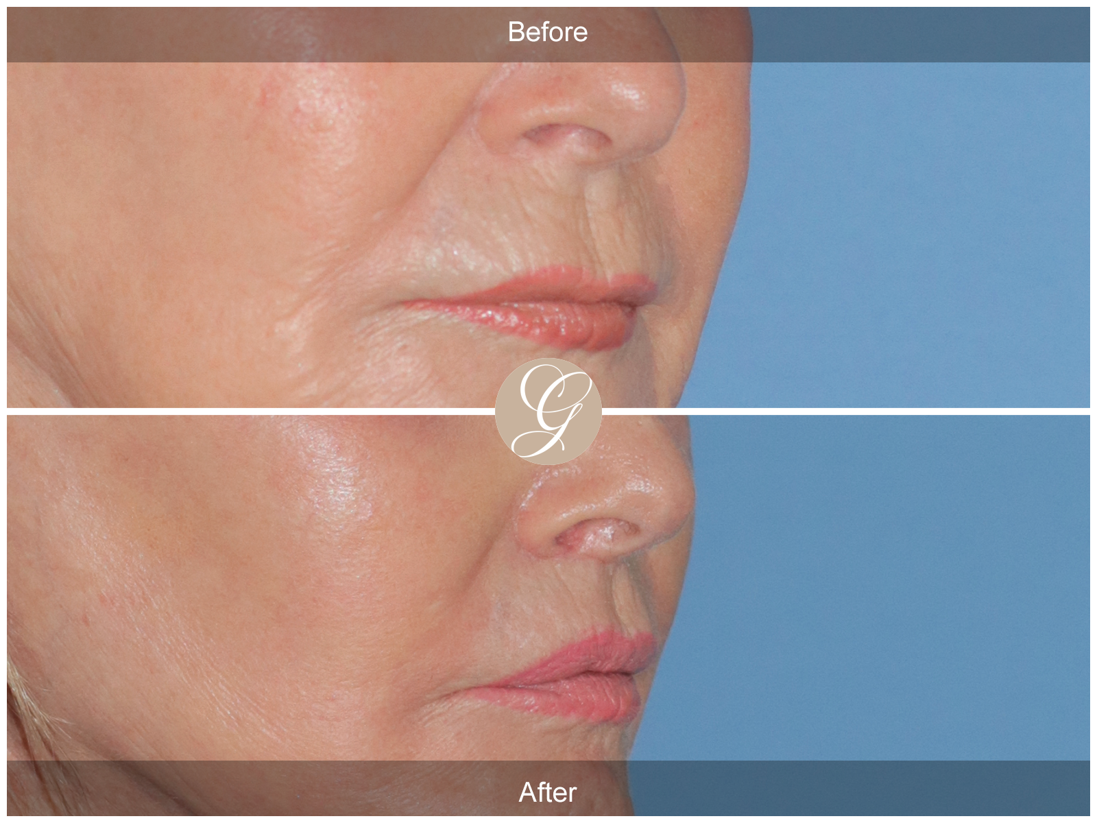 Lip Lift 0021 Image
