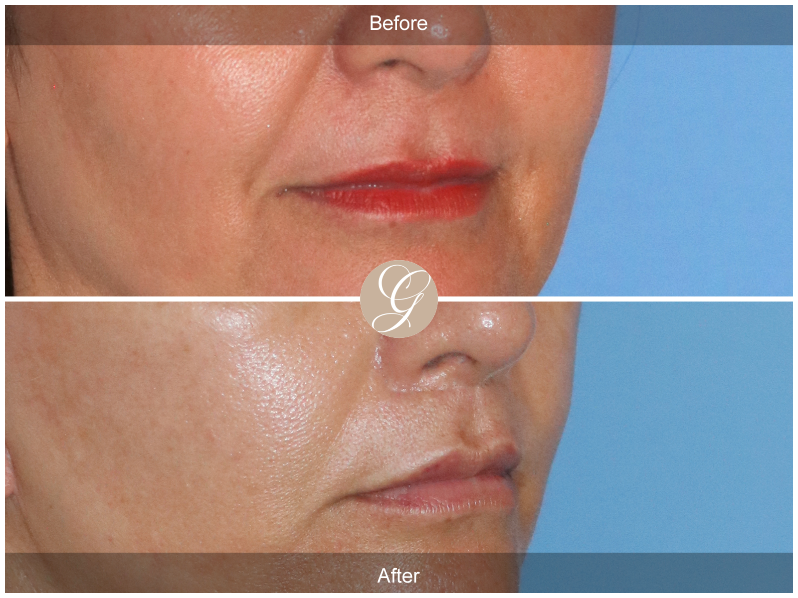 Lip Lift 5291 Image