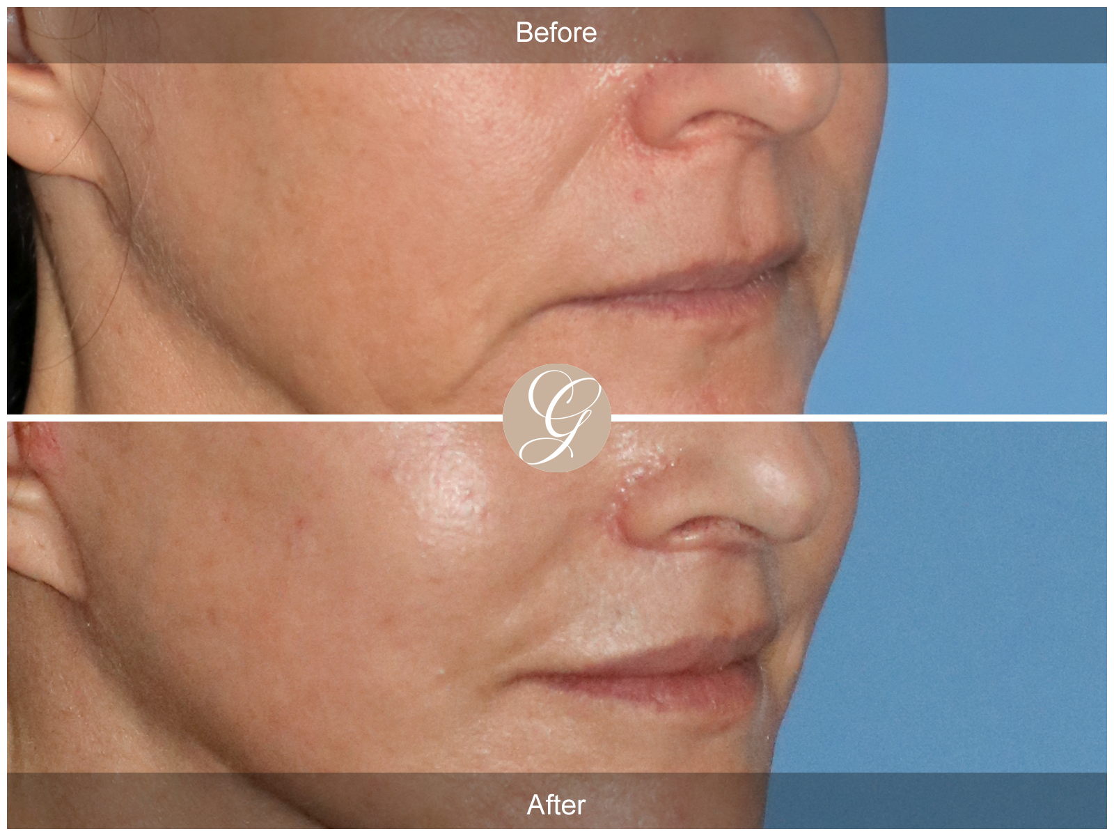 Lip Lift 8831 Image