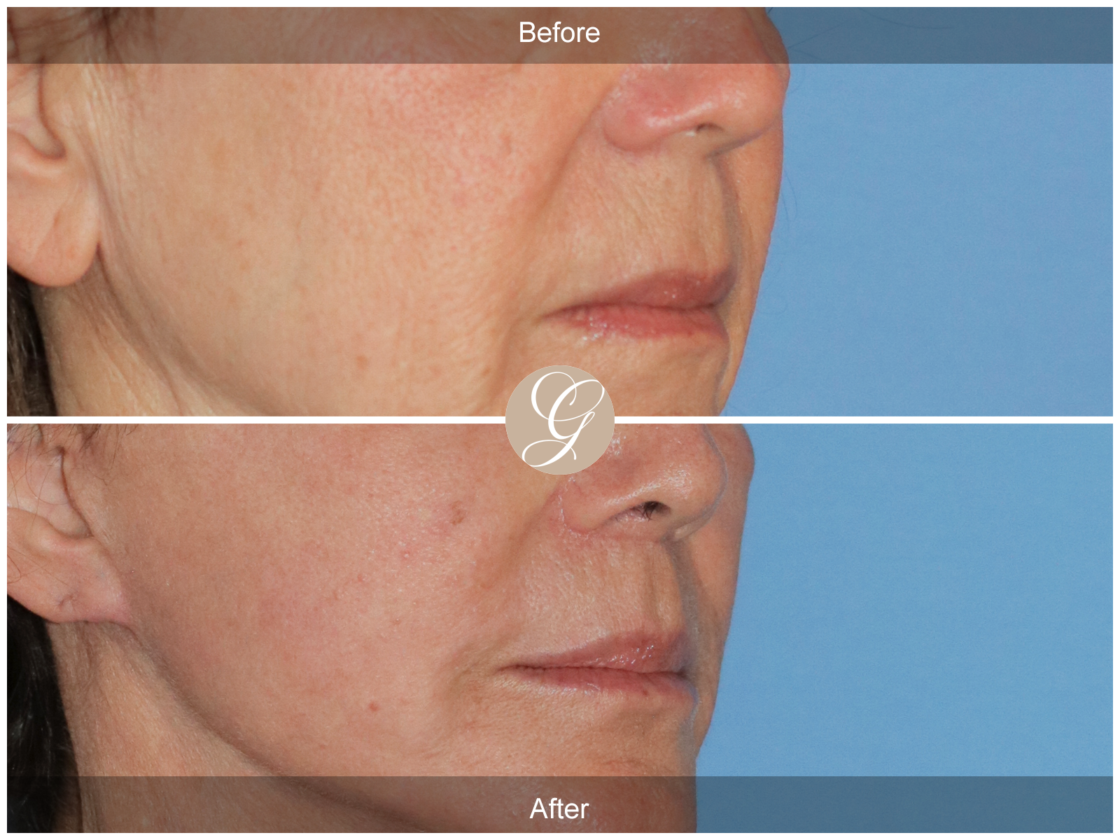 Lip Lift 0833 Image