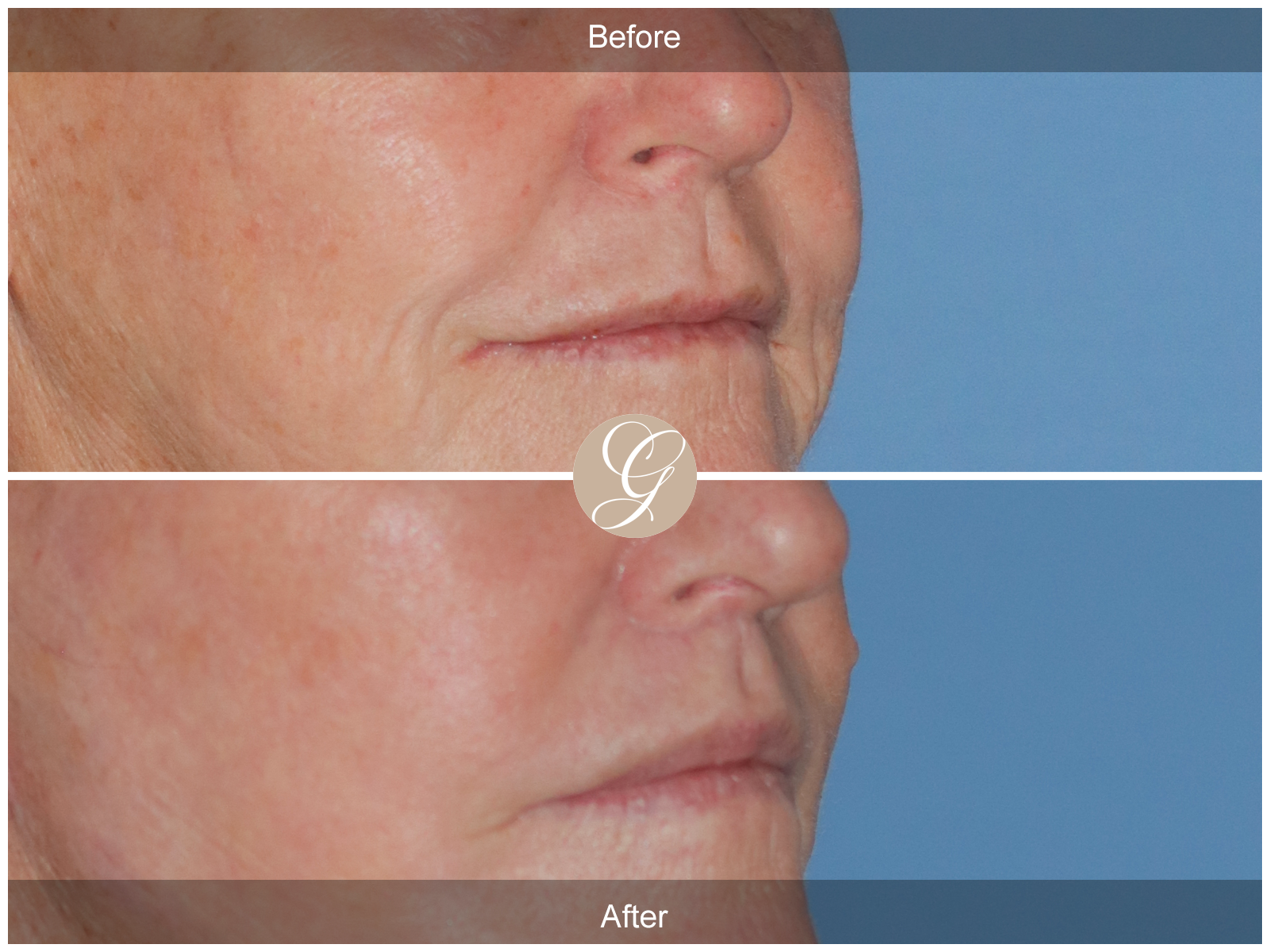 Lip Lift 5441 Image