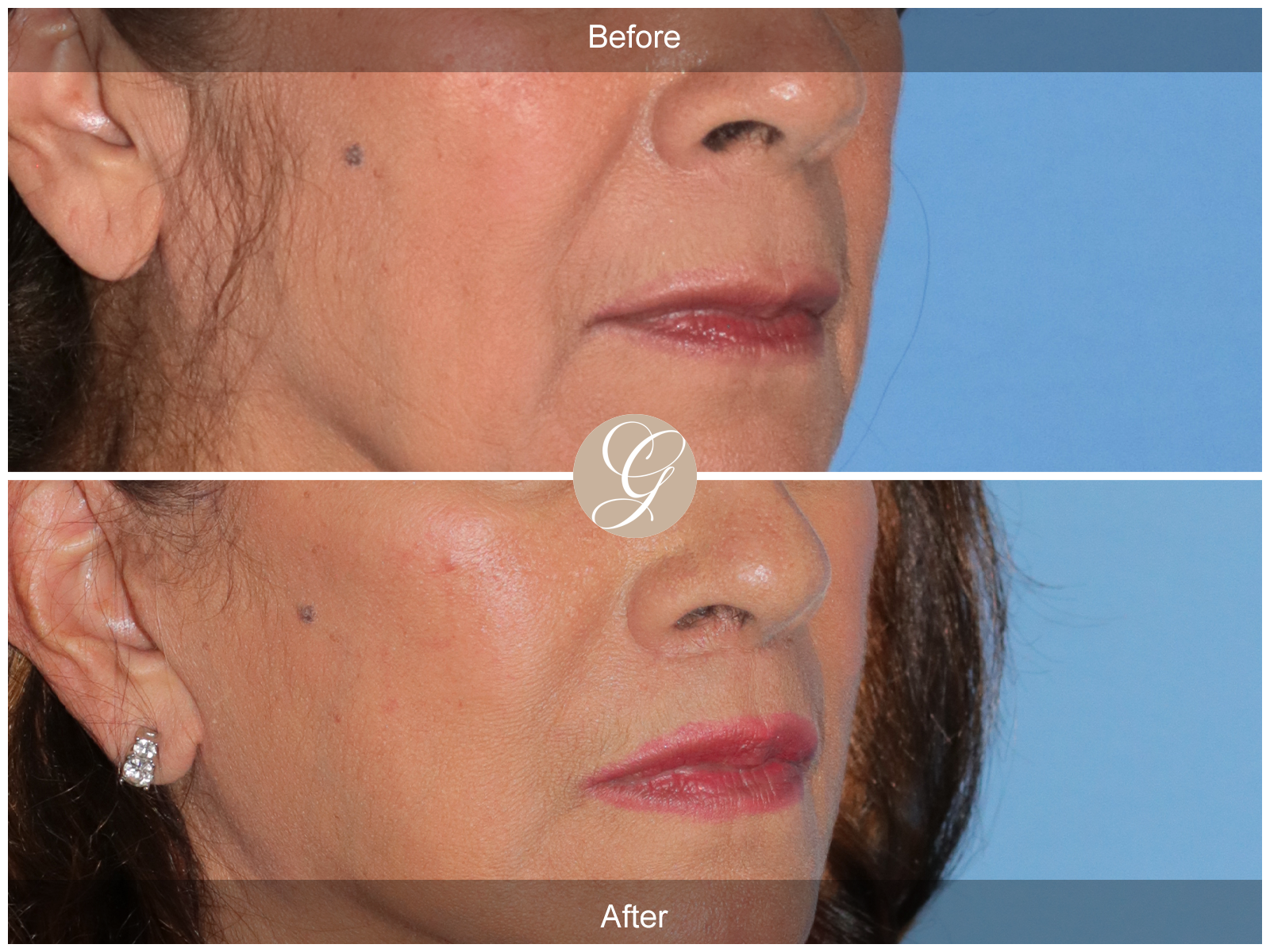 Lip Lift 9082 Image