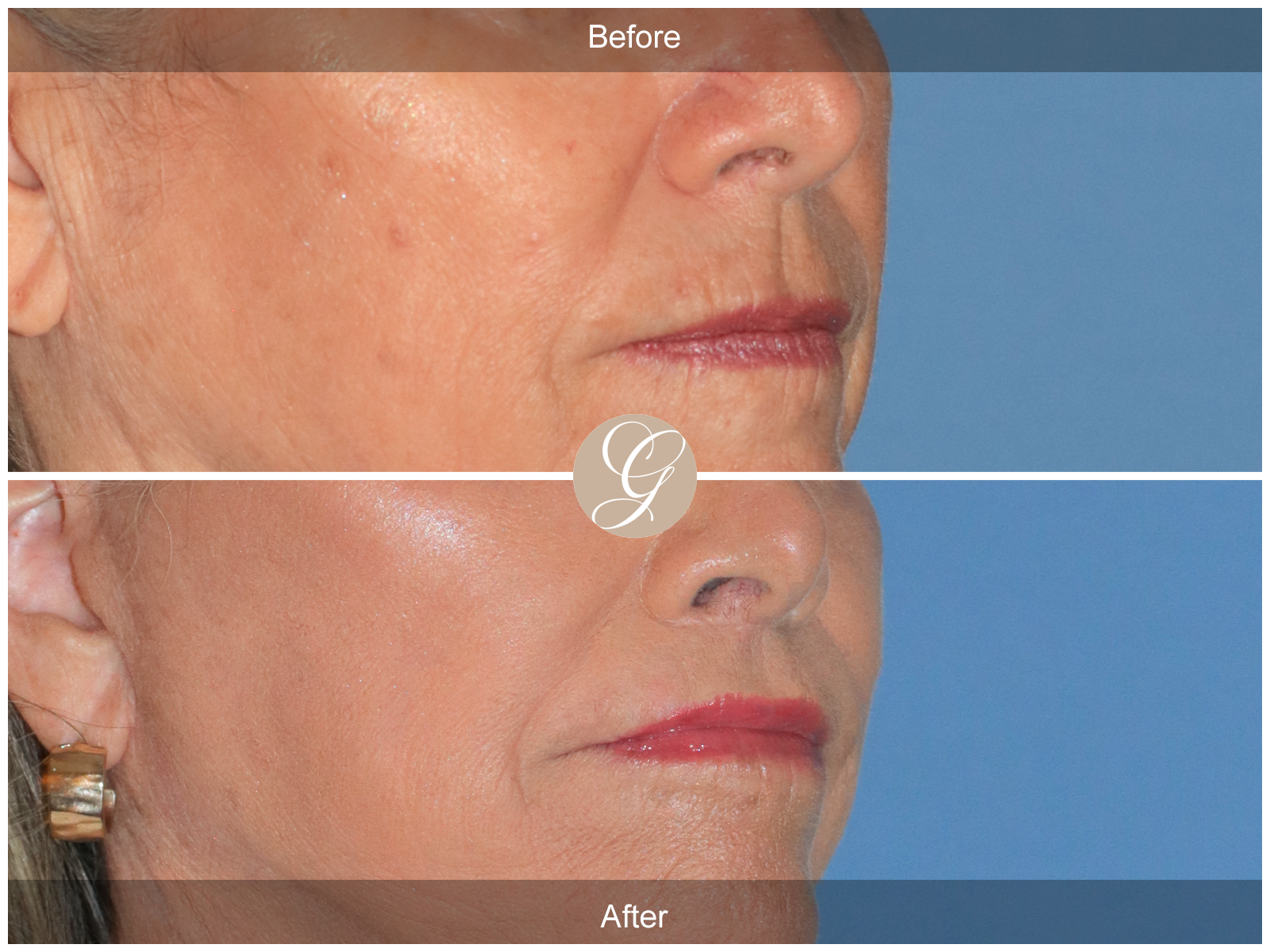 Lip Lift 0041 Image