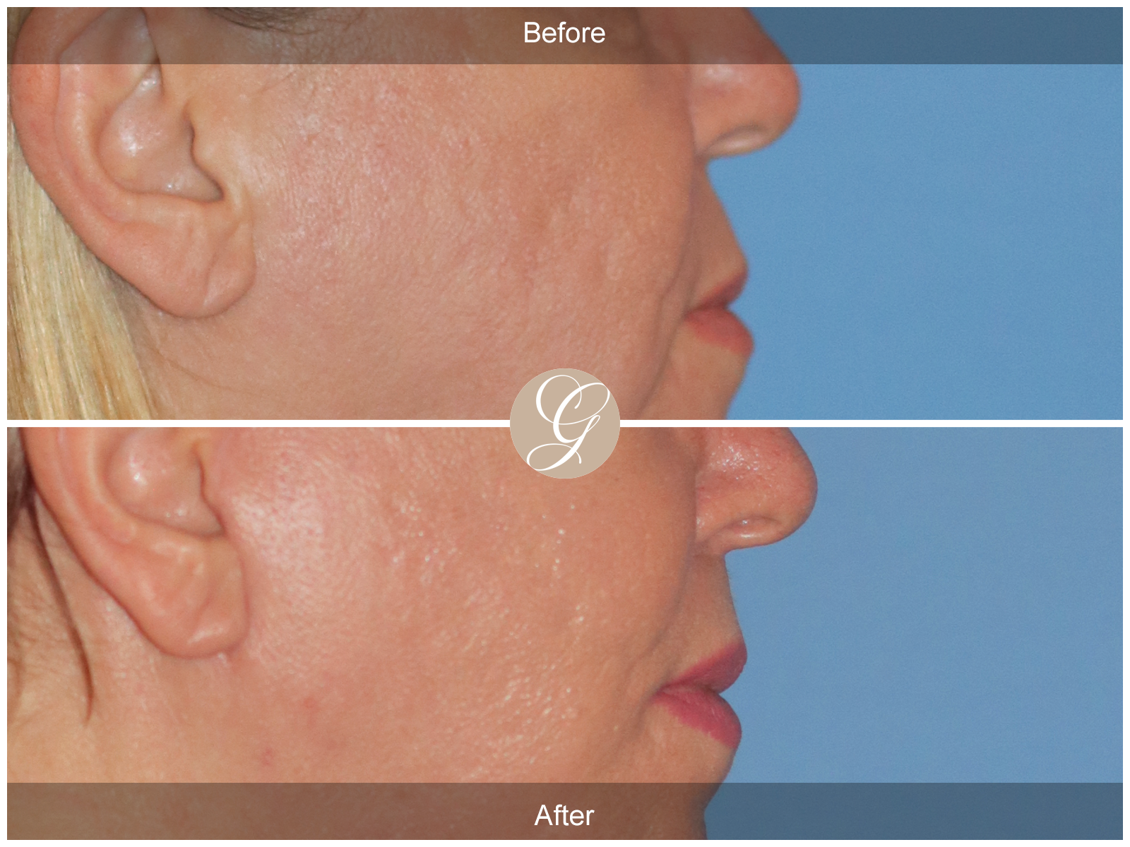 Lip Lift 9655 Image