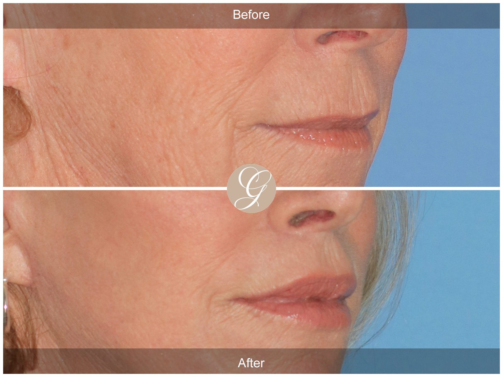 Lip Lift 2100 Image