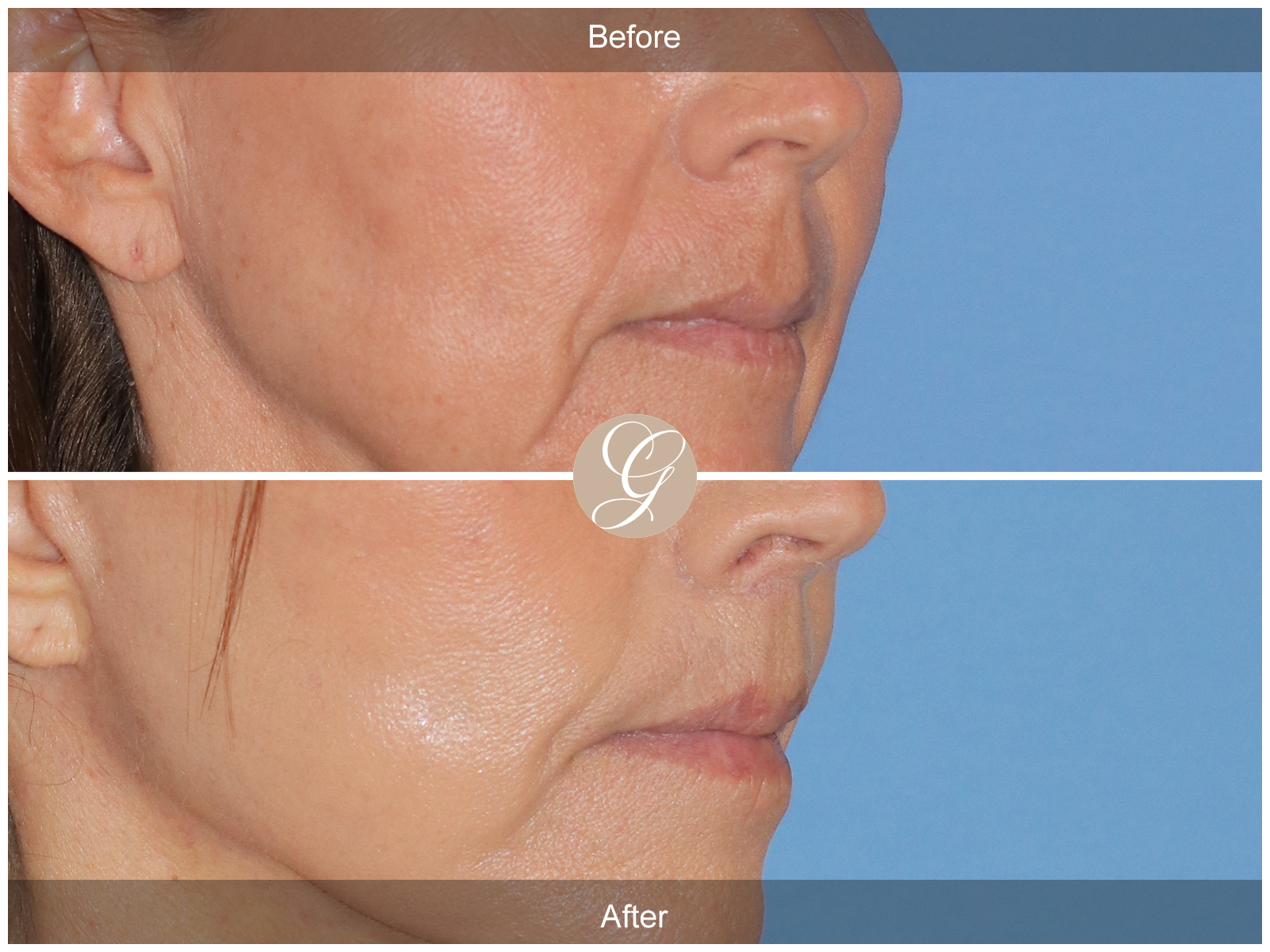 Lip Lift 4821 Image