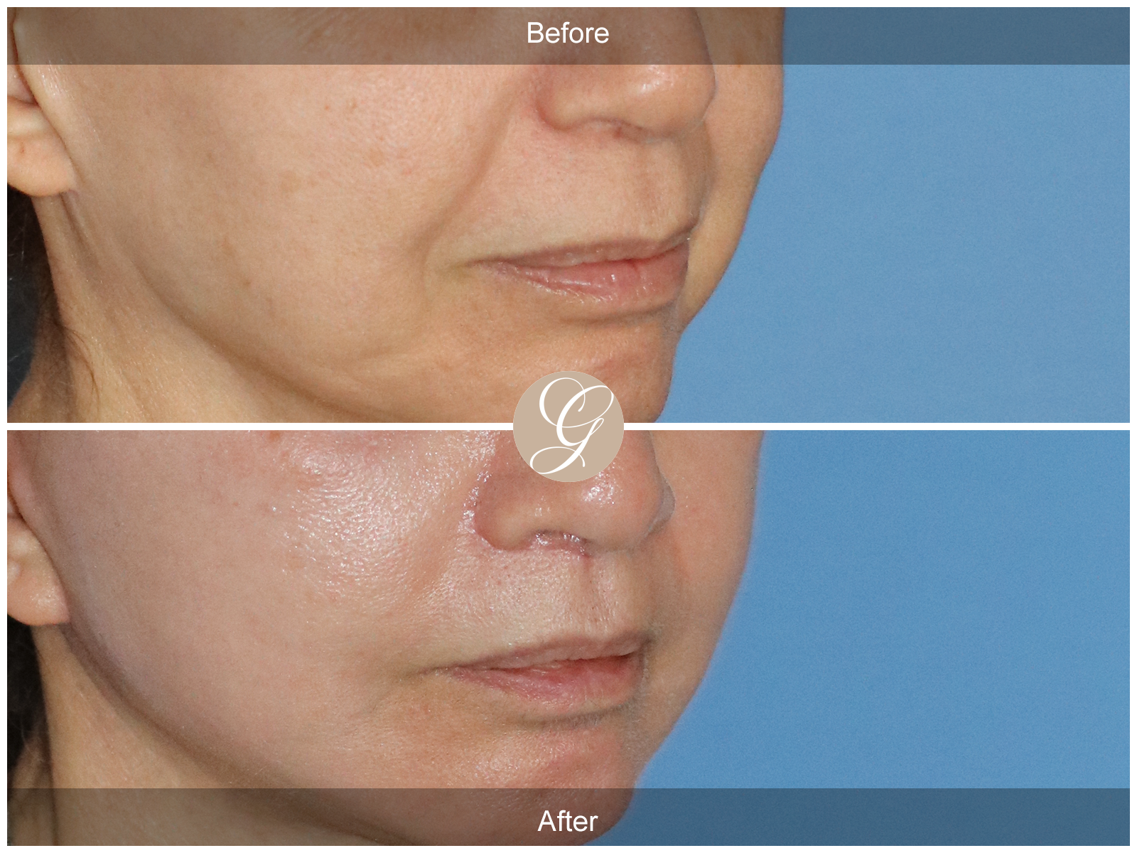 Lip Lift 0456 Image
