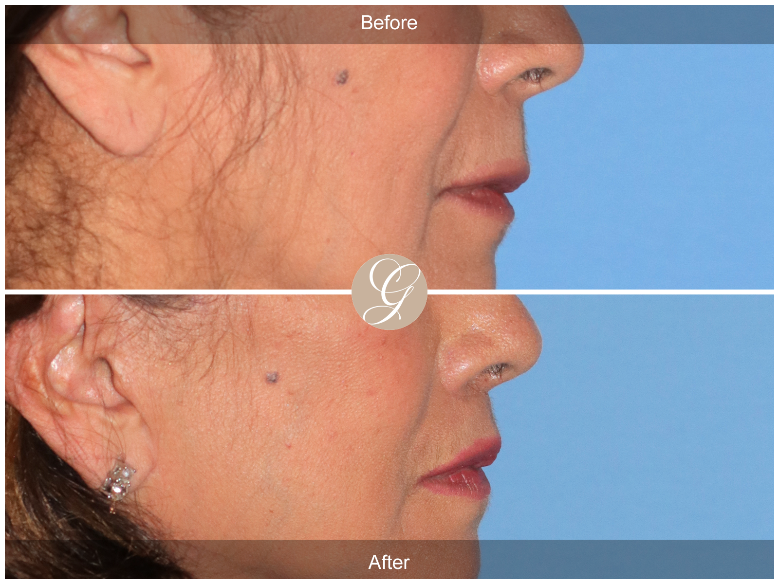 Lip Lift 9082 Image