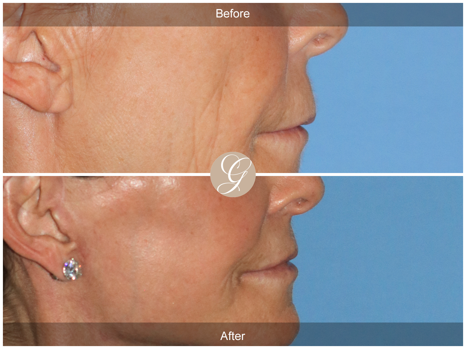 Lip Lift 7094 Image