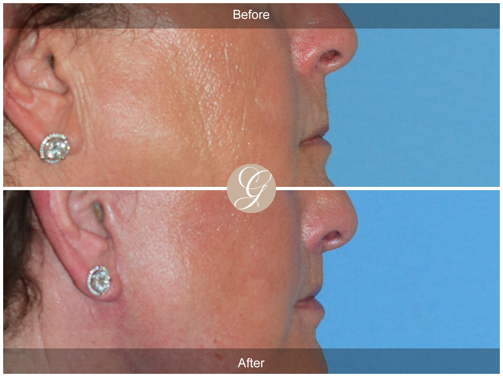 Lip Lift 8944 Image