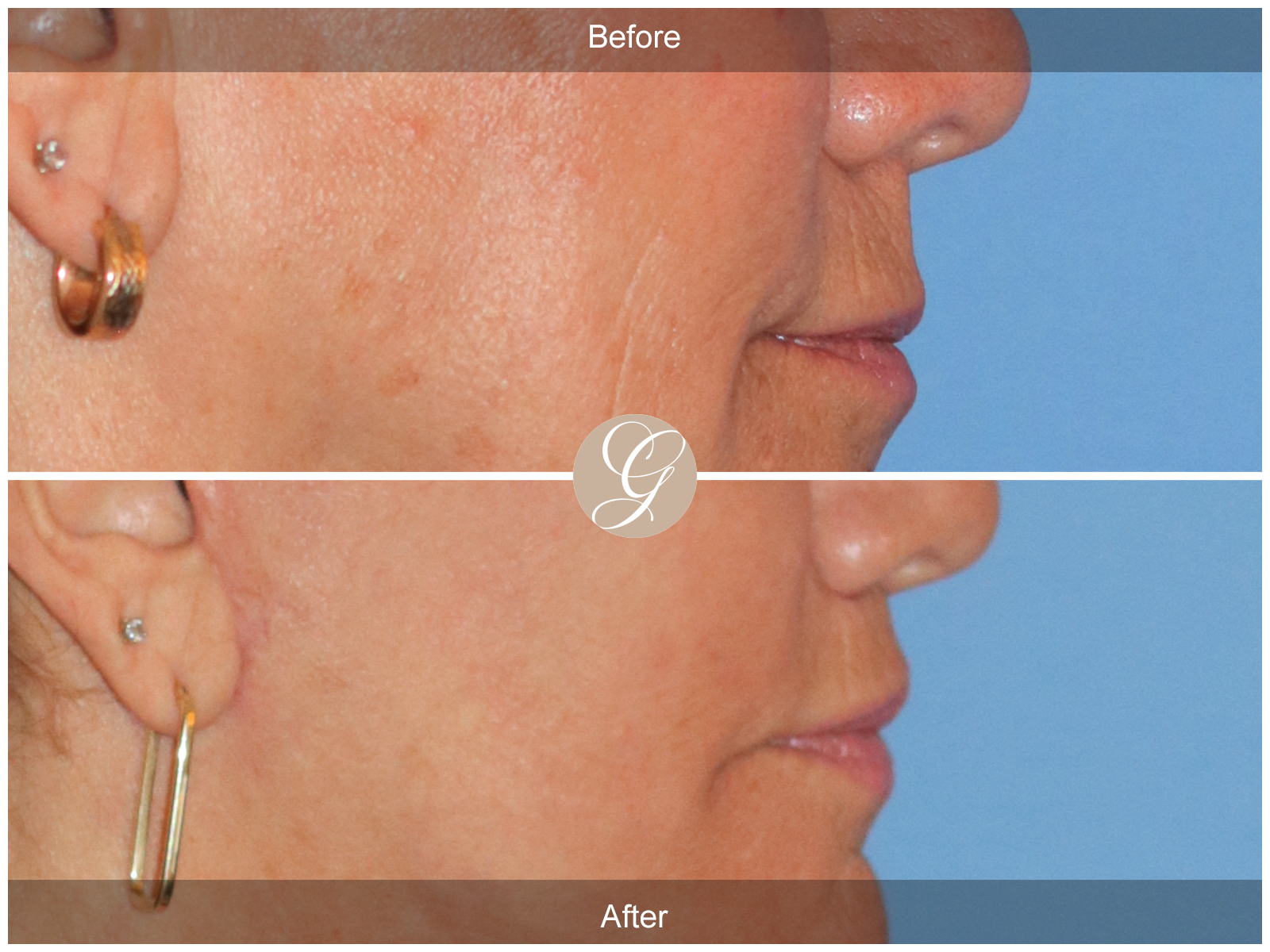 Lip Lift 2096 Image