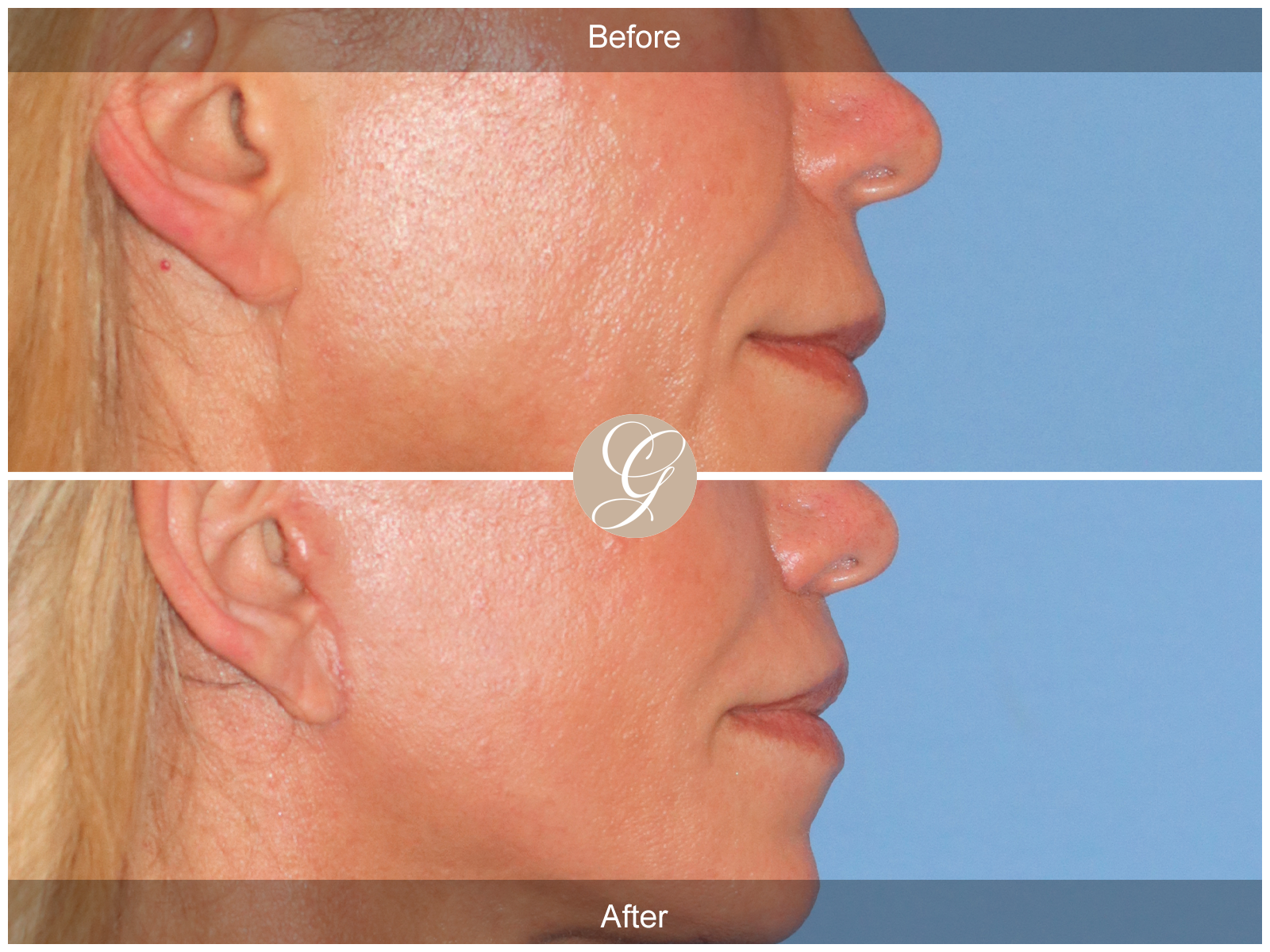 Lip Lift 9245 Image