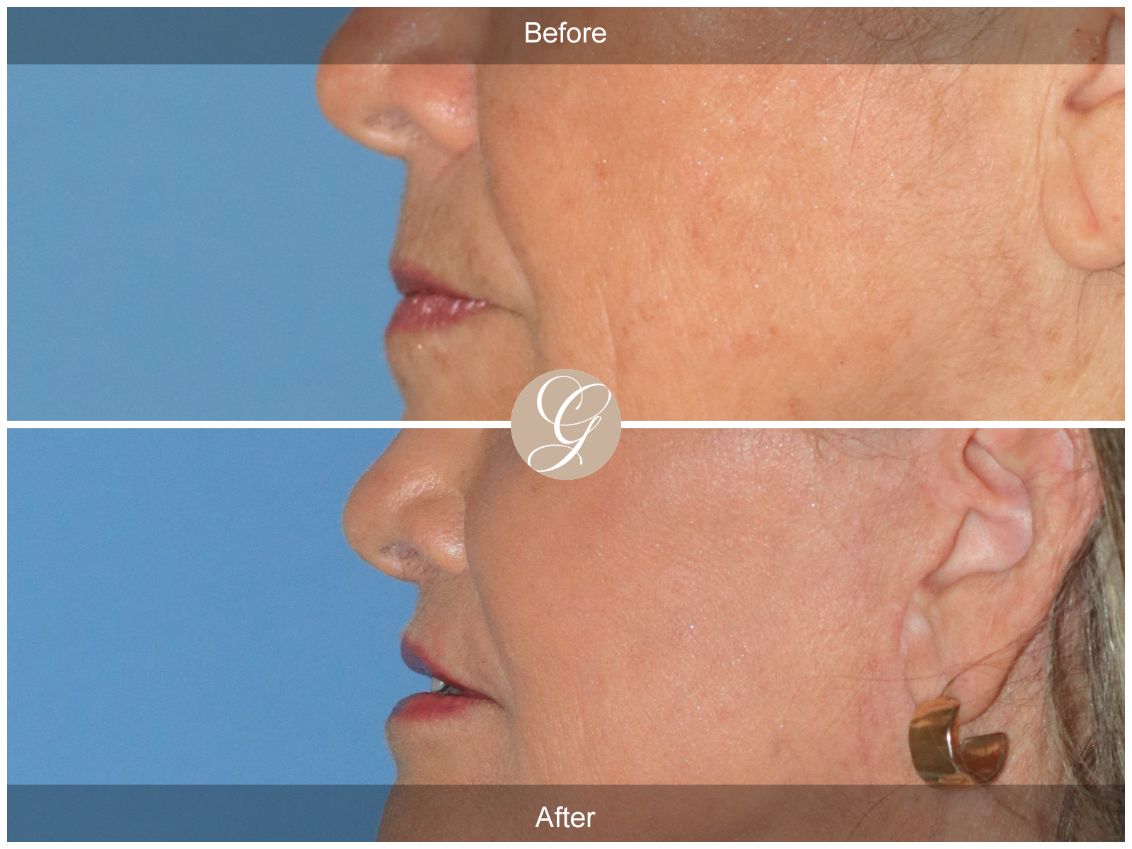 Lip Lift 0041 Image