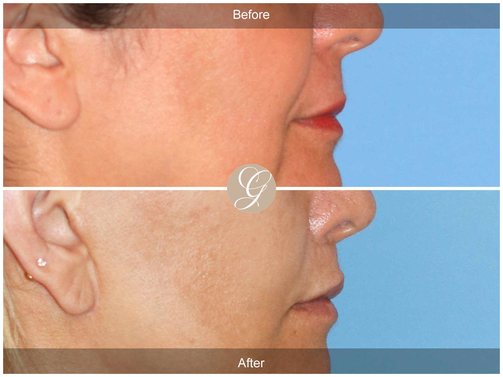 Lip Lift 5291 Image