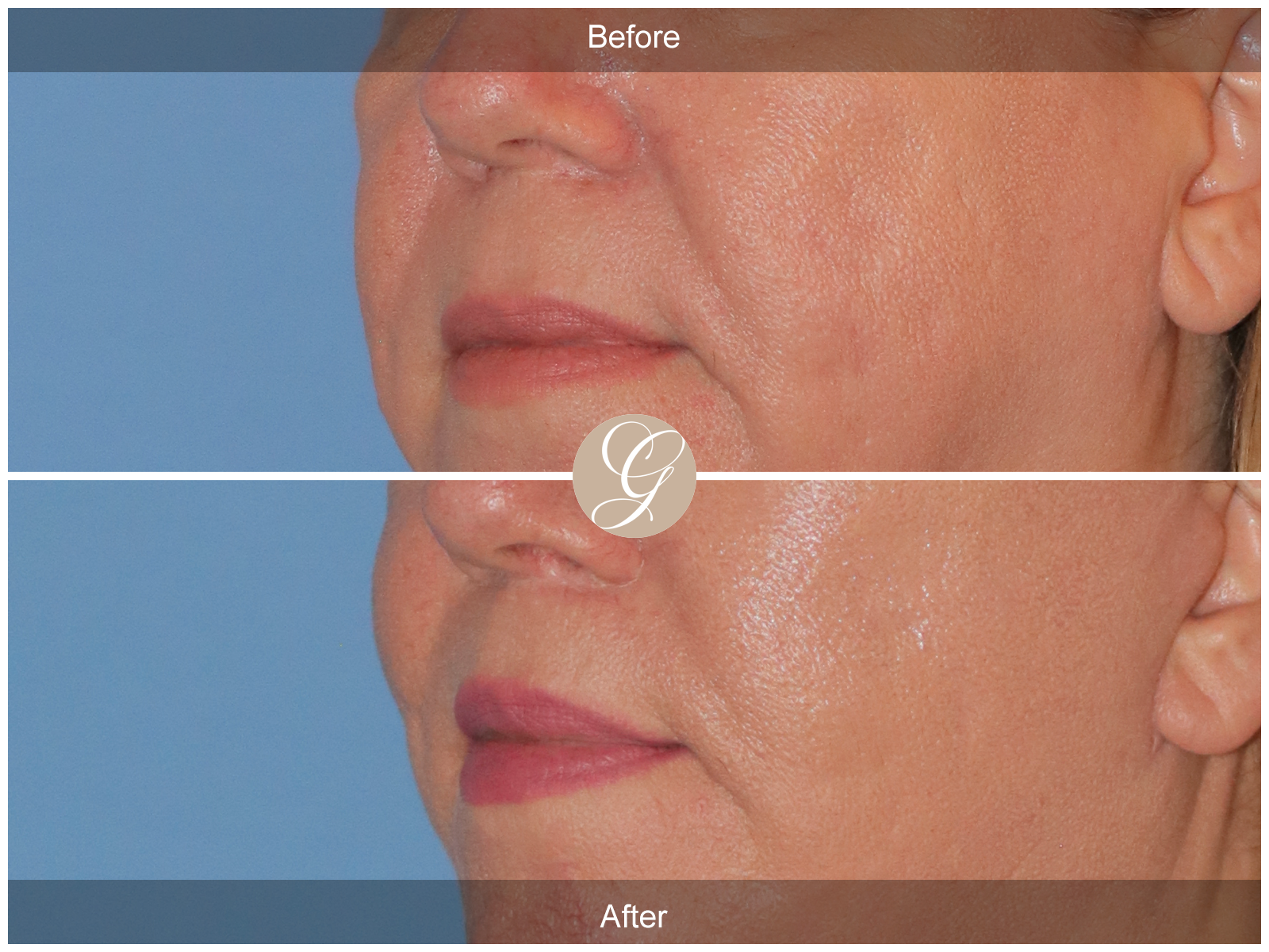 Lip Lift 9655 Image