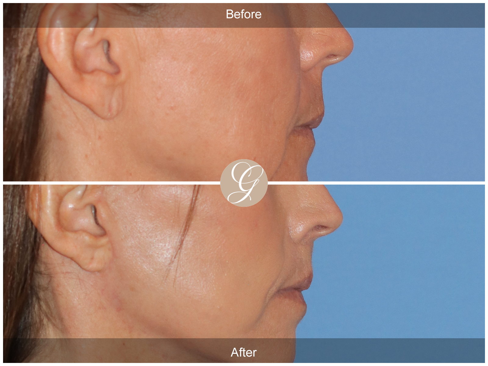 Lip Lift 4821 Image