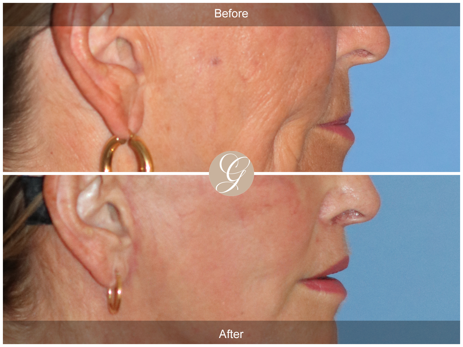 Lip Lift 5523 Image