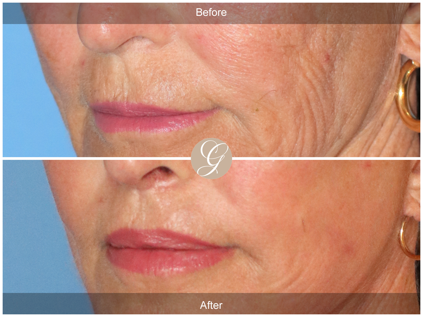 Lip Lift 5523 Image