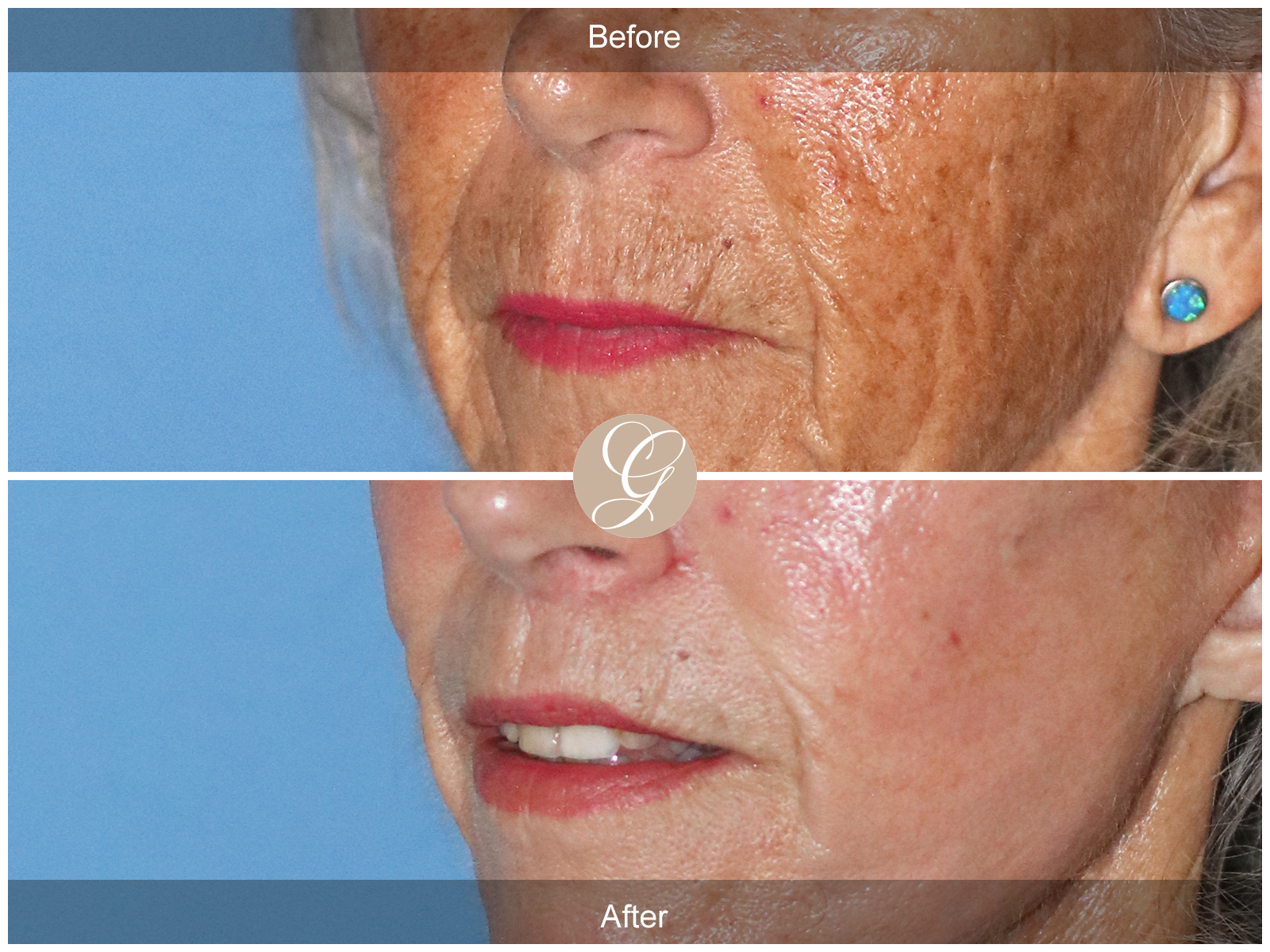 Lip Lift 0883 Image