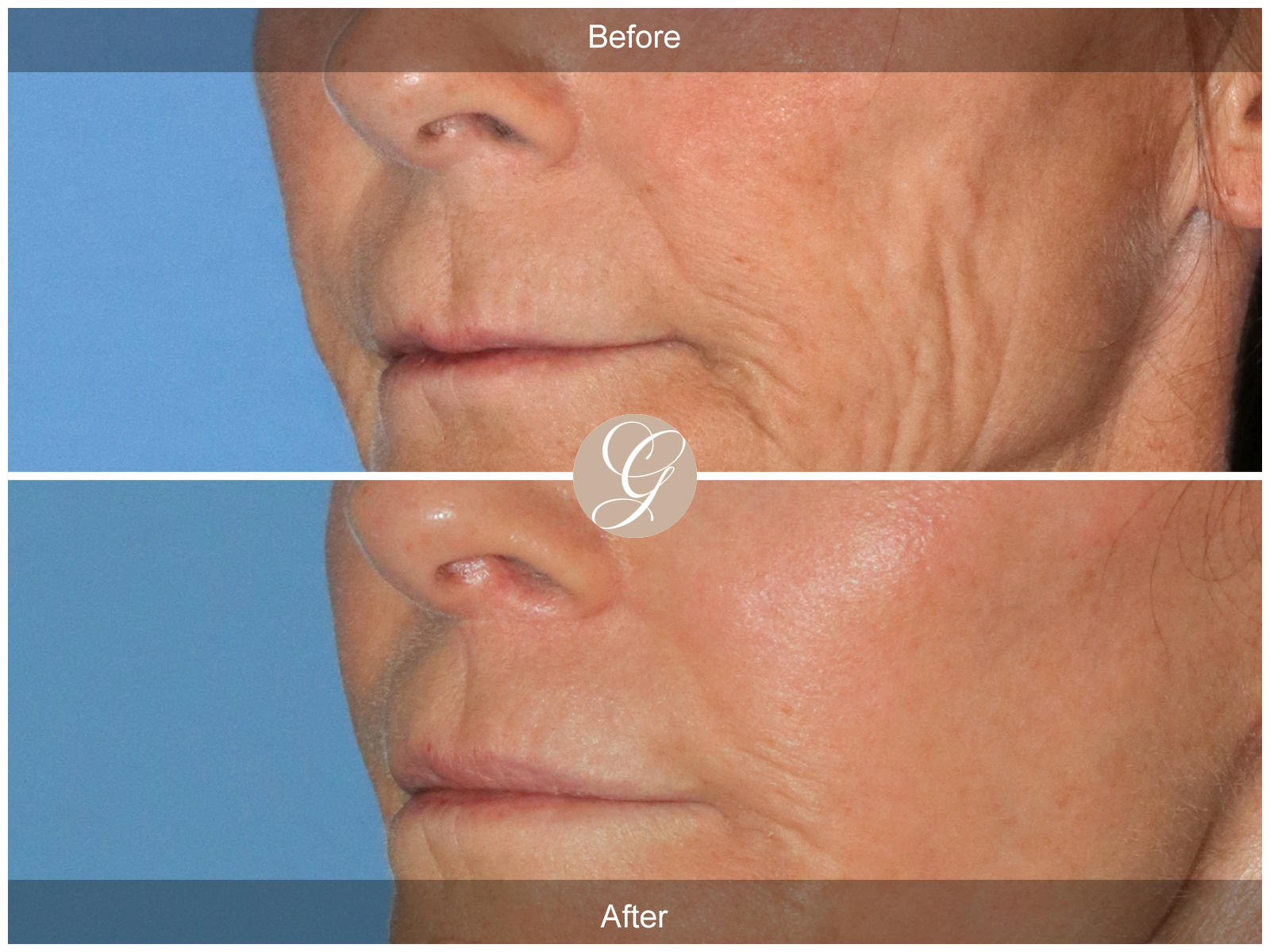 Lip Lift 7094 Image