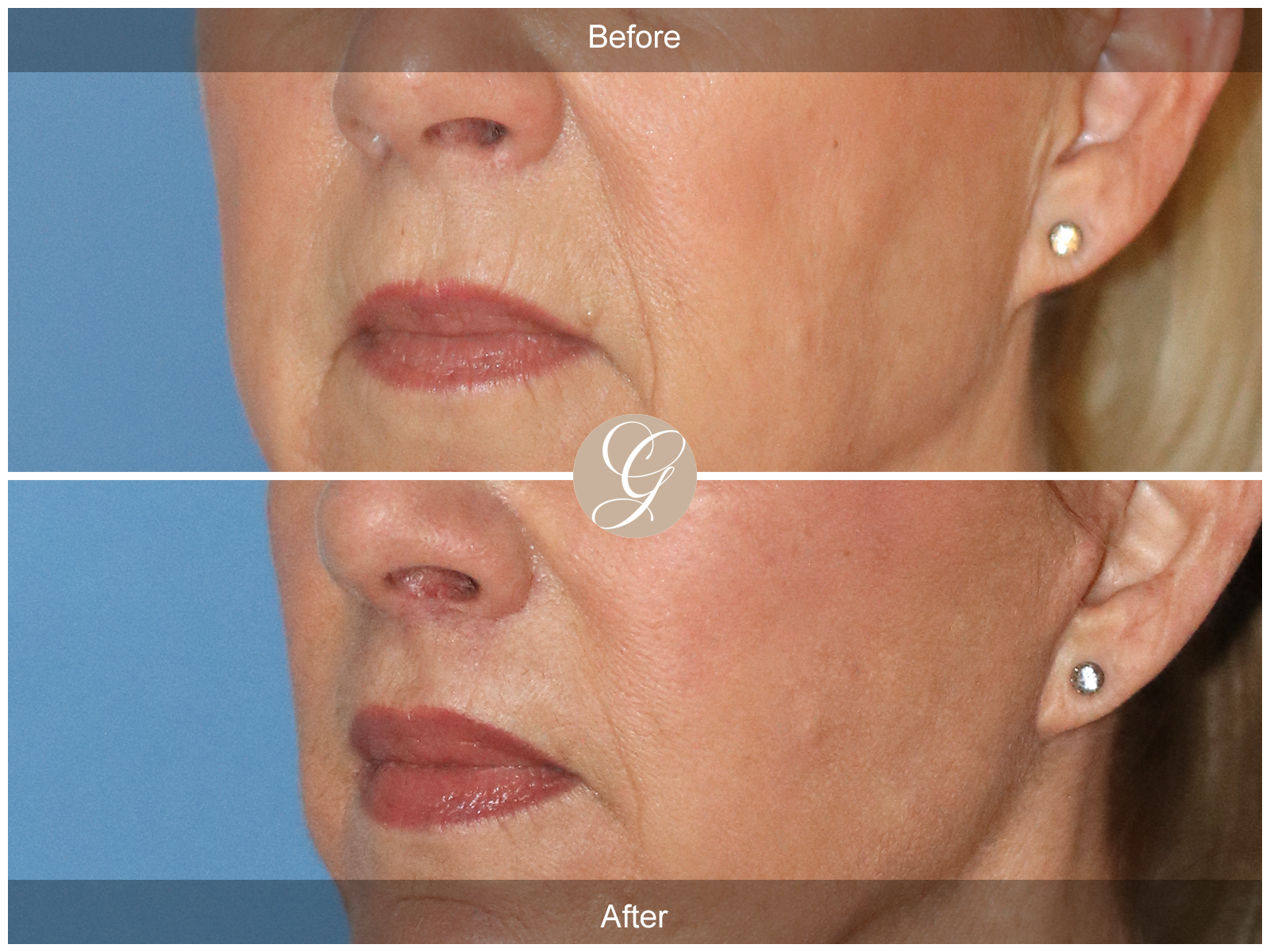 Lip Lift 0994 Image