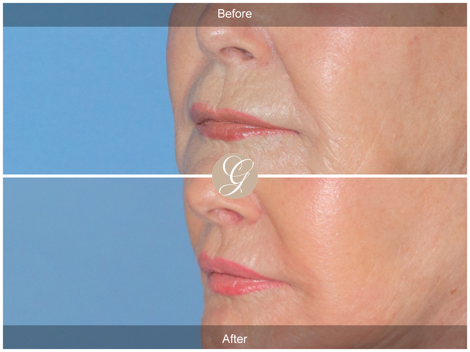 Lip Lift 0021 Image