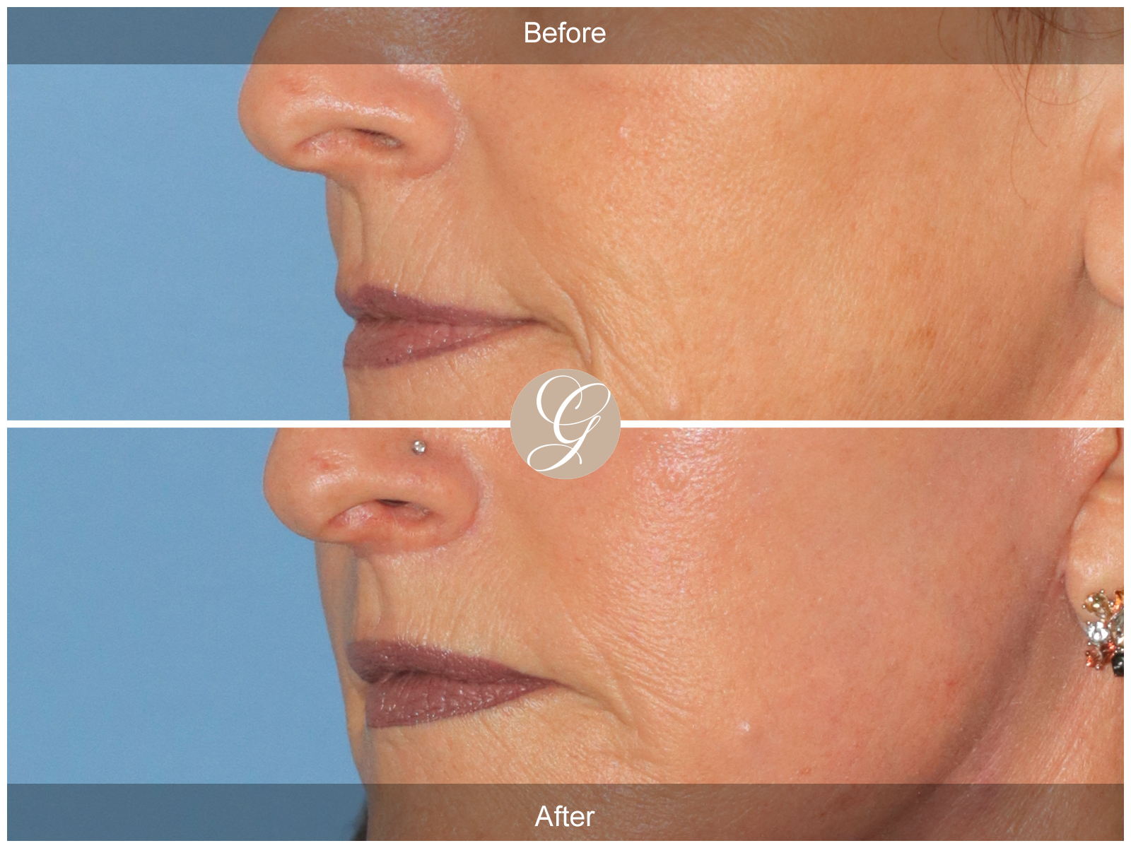 Lip Lift 0822 Image