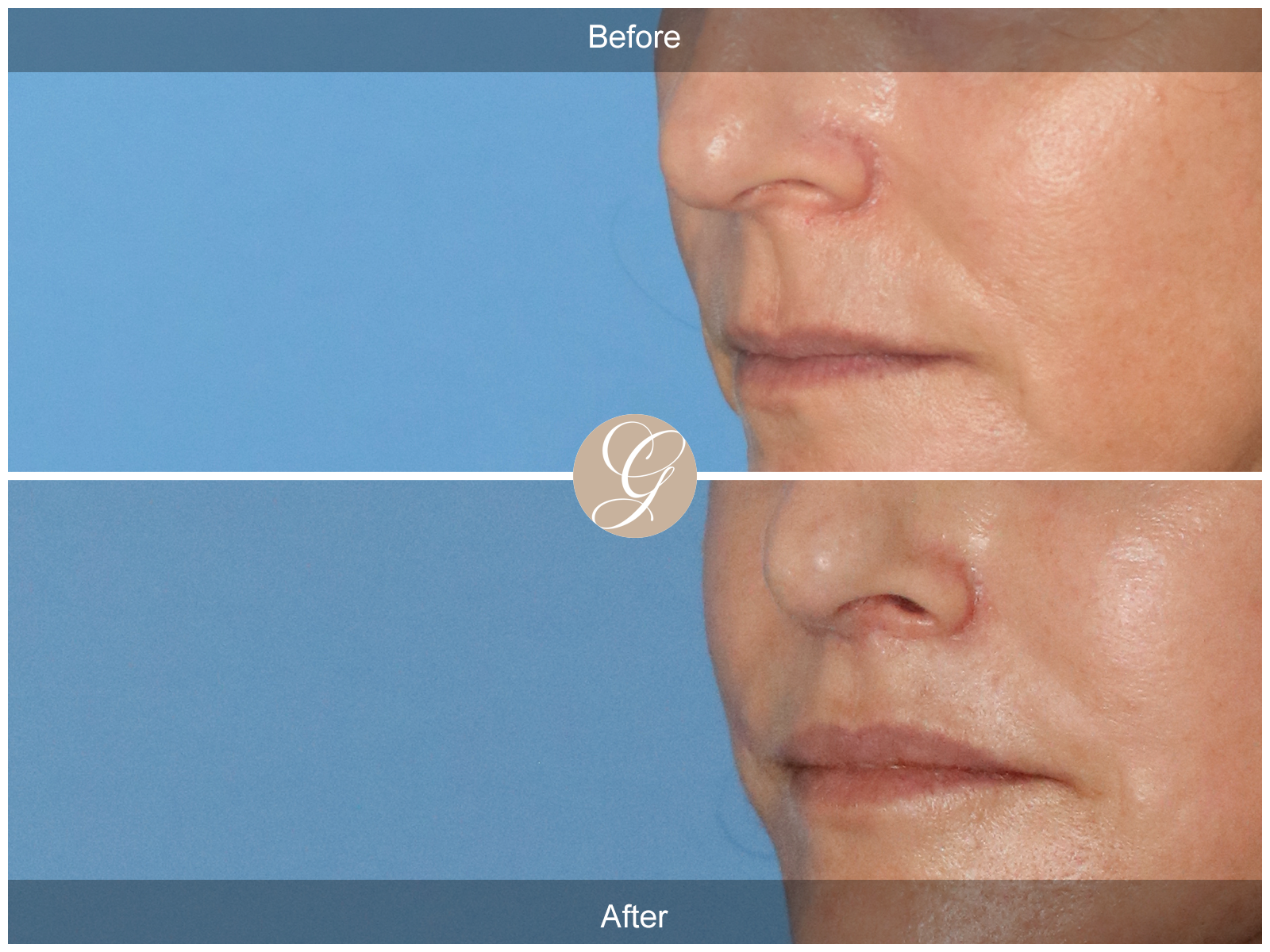 Lip Lift 8831 Image