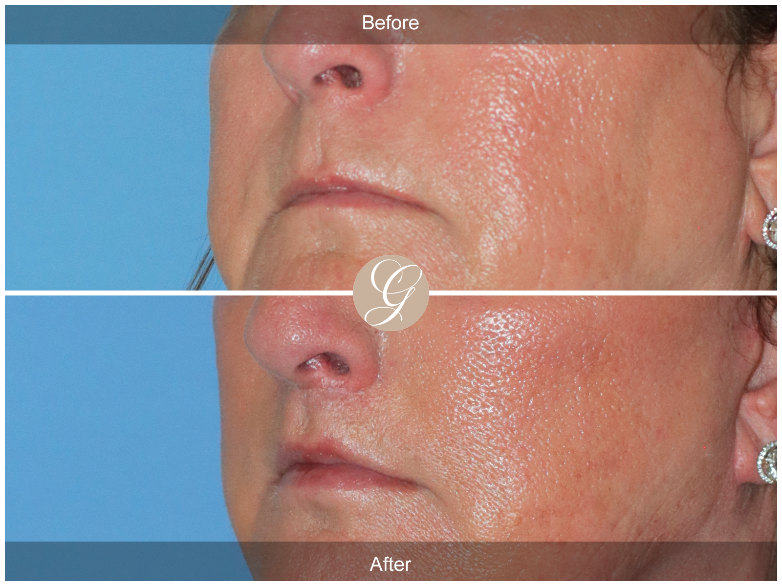 Lip Lift 8944 Image