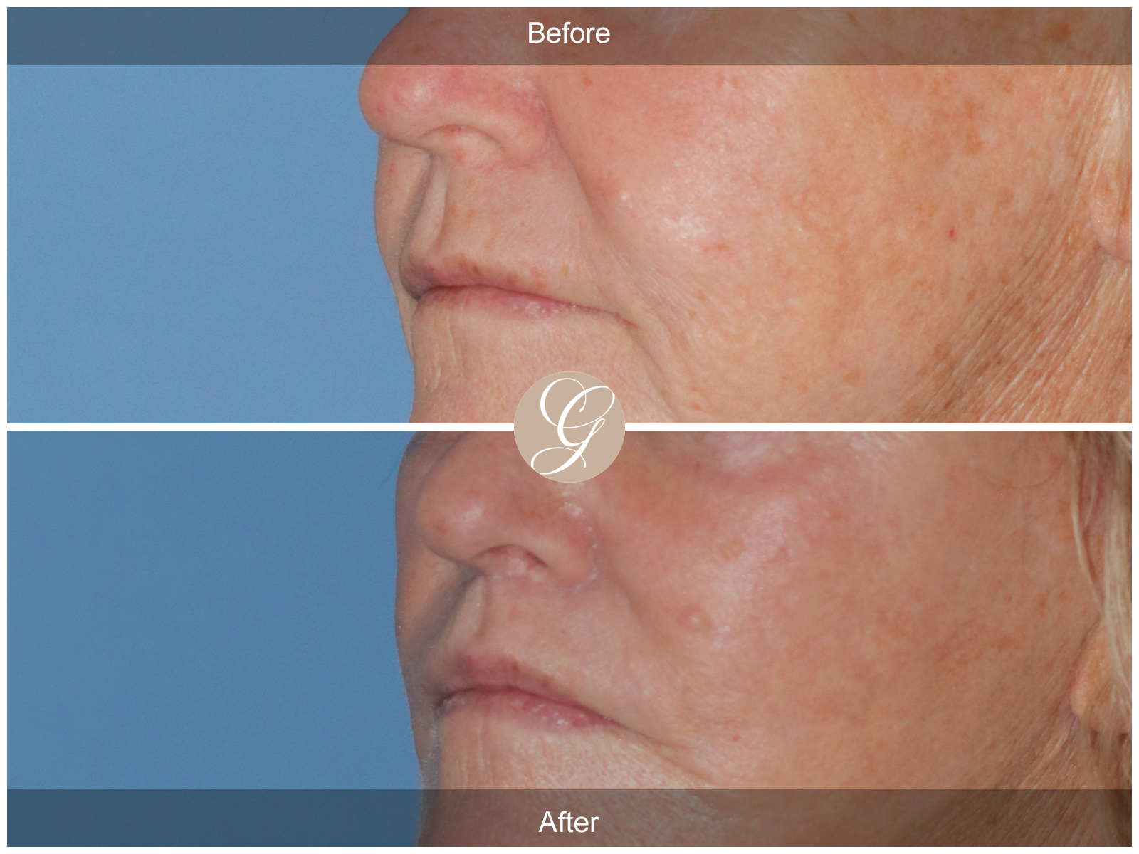 Lip Lift 5441 Image