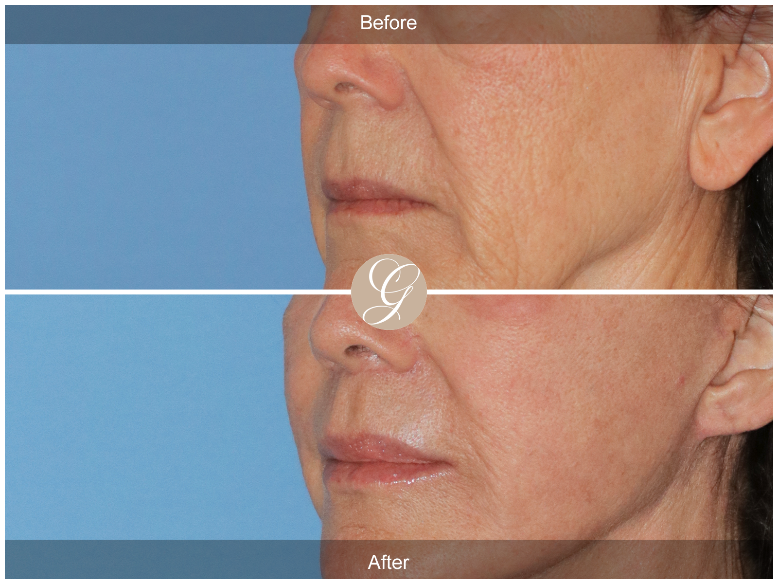 Lip Lift 0833 Image
