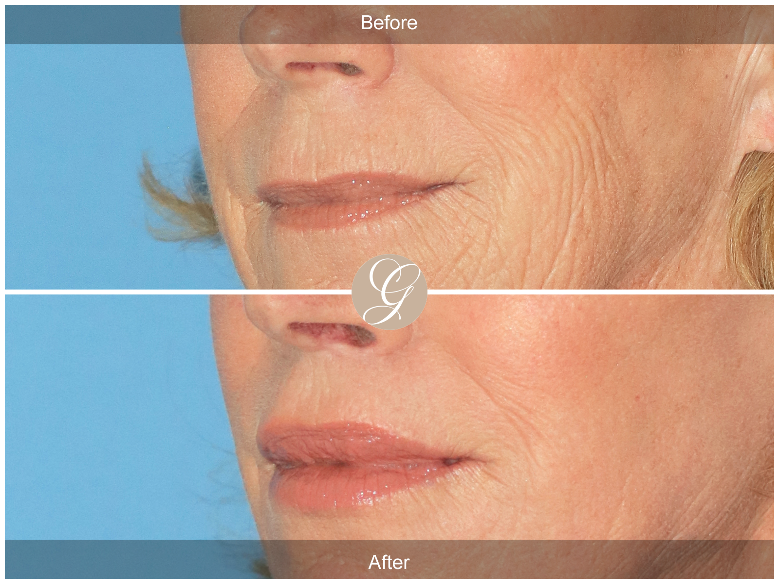 Lip Lift 2100 Image