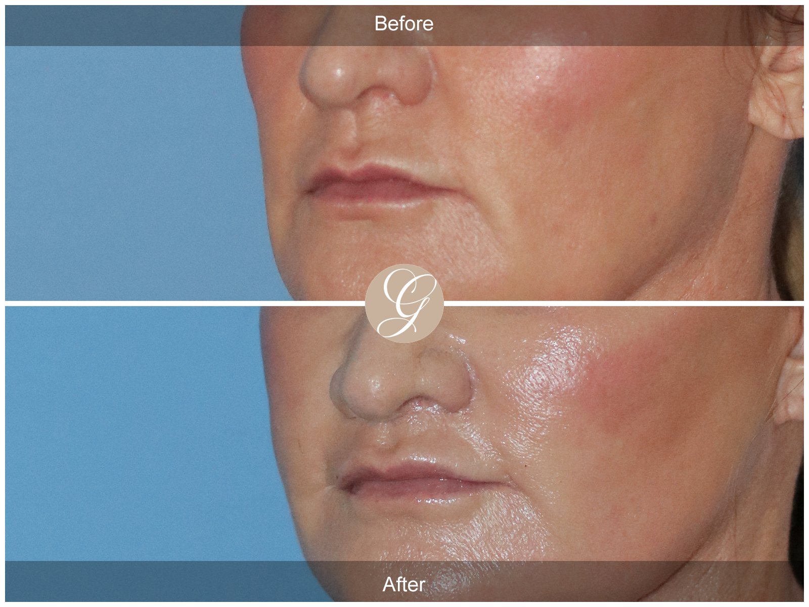 Lip Lift 0927 Image