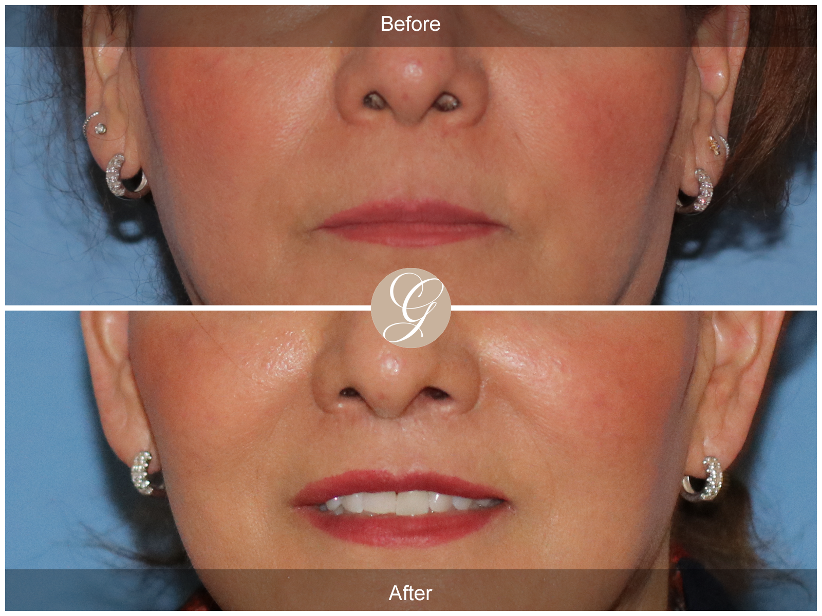 Lip Lift 6432 Image