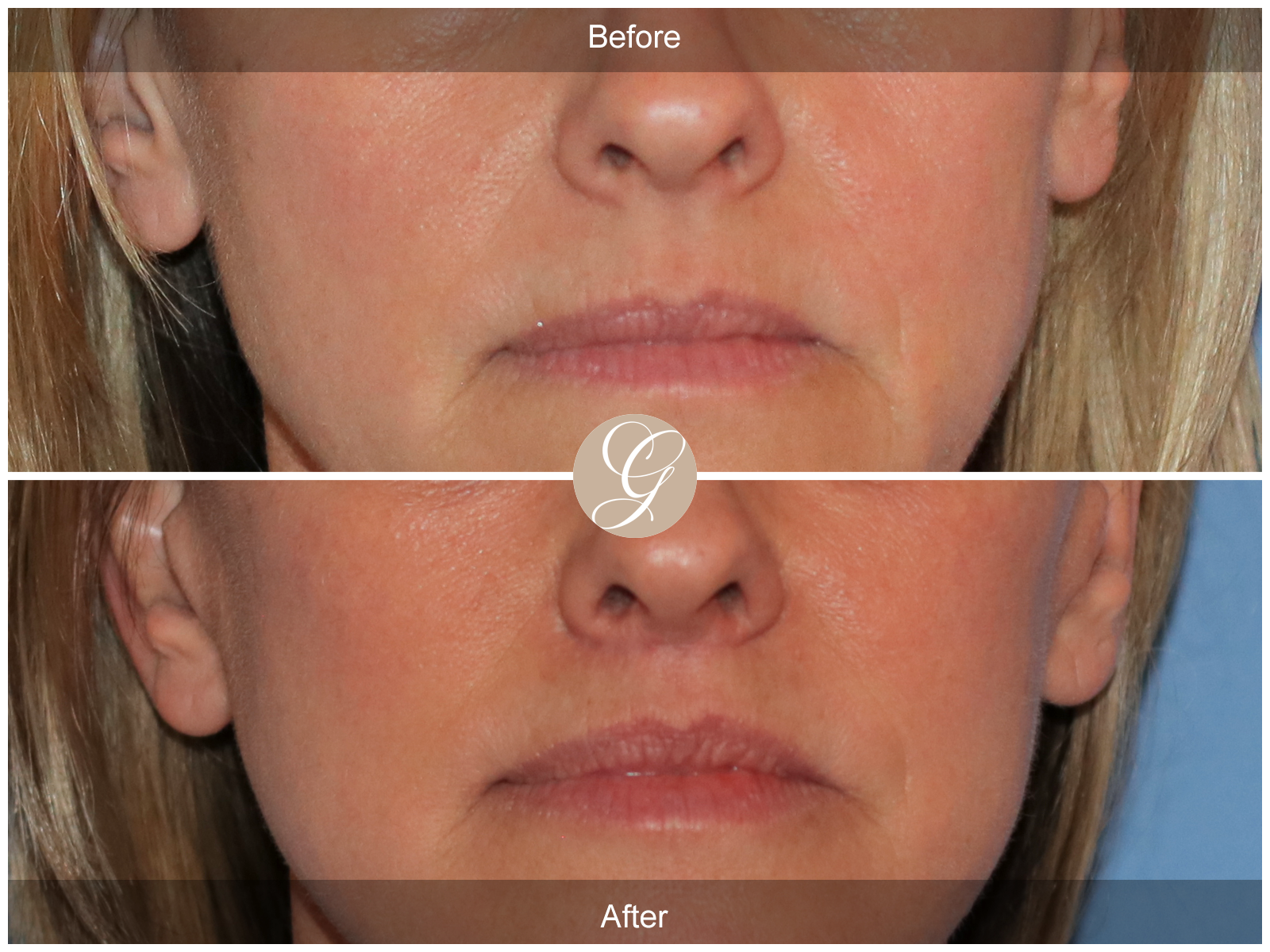 Lip Lift 8744 Image