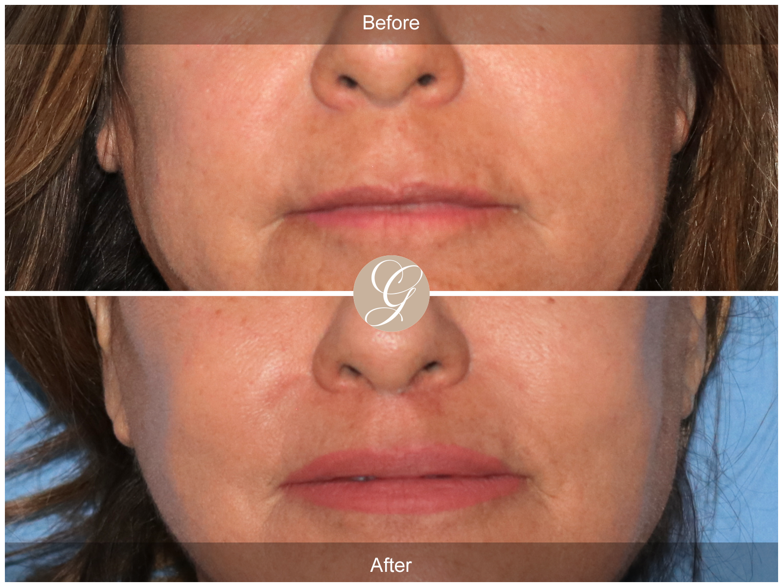 Lip Lift 9045 Image