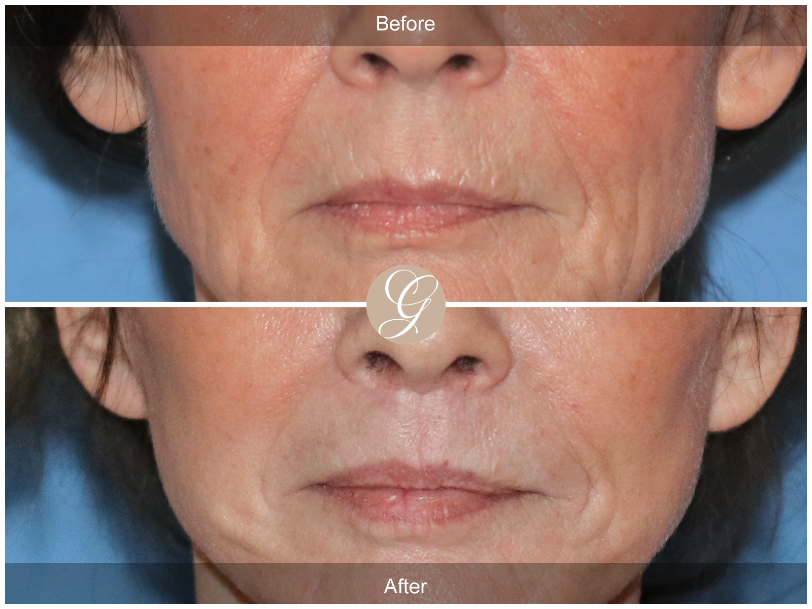 Lip Lift 2201 Image