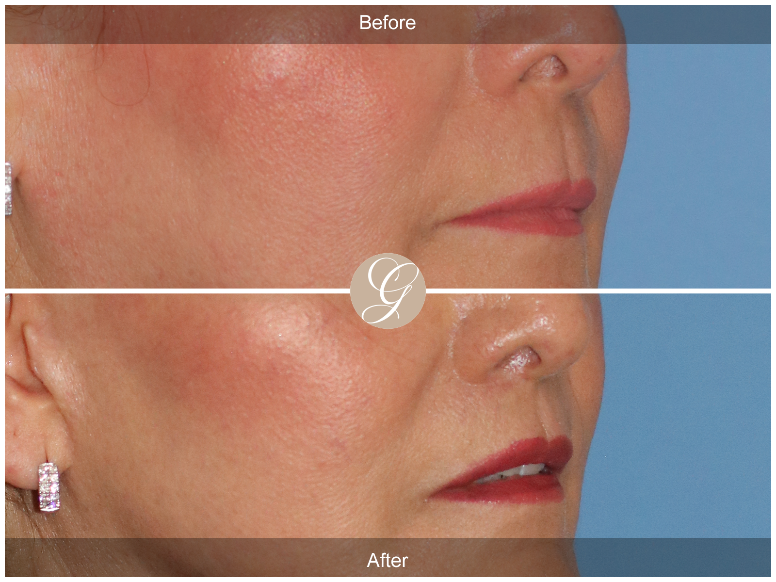 Lip Lift 6432 Image