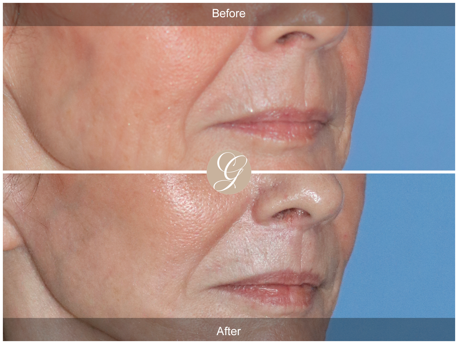 Lip Lift 2201 Image