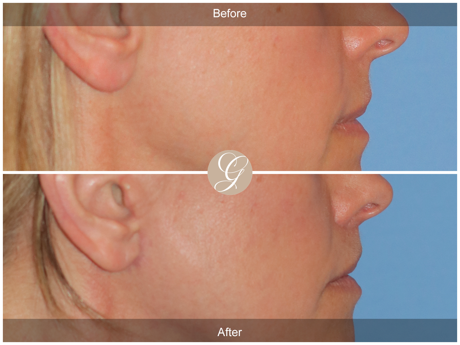 Lip Lift 8744 Image