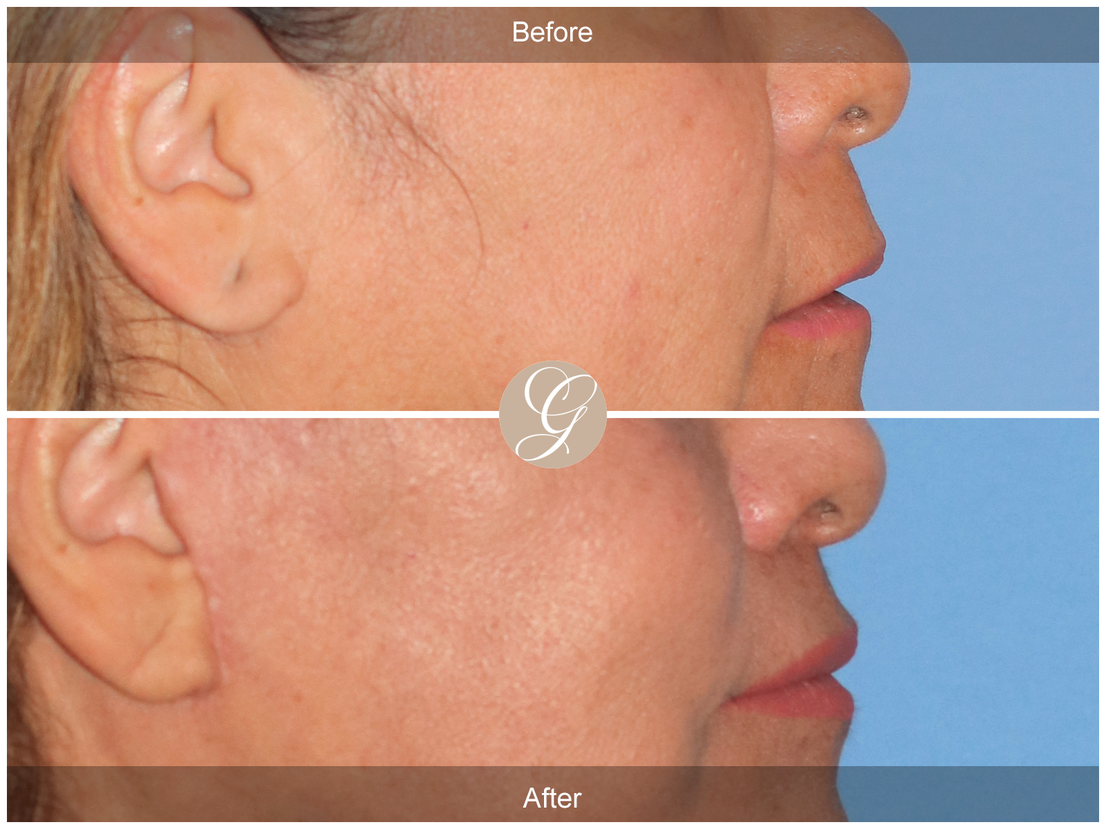Lip Lift 9045 Image