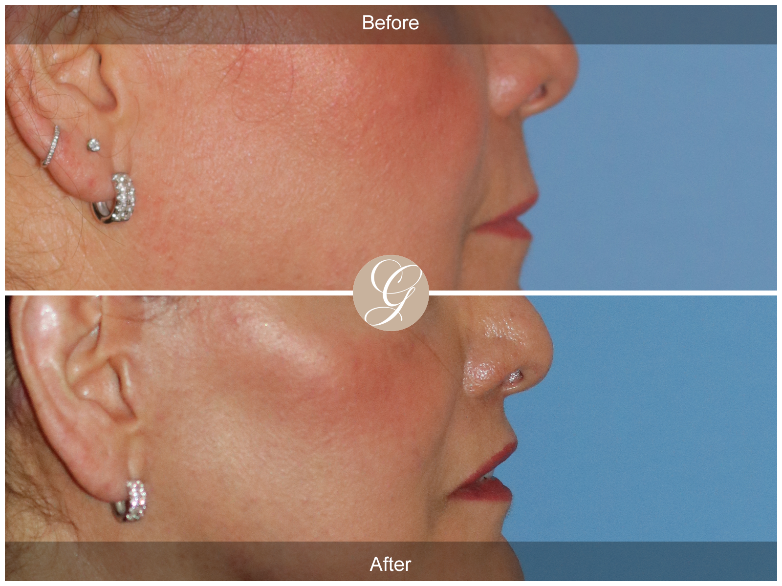 Lip Lift 6432 Image