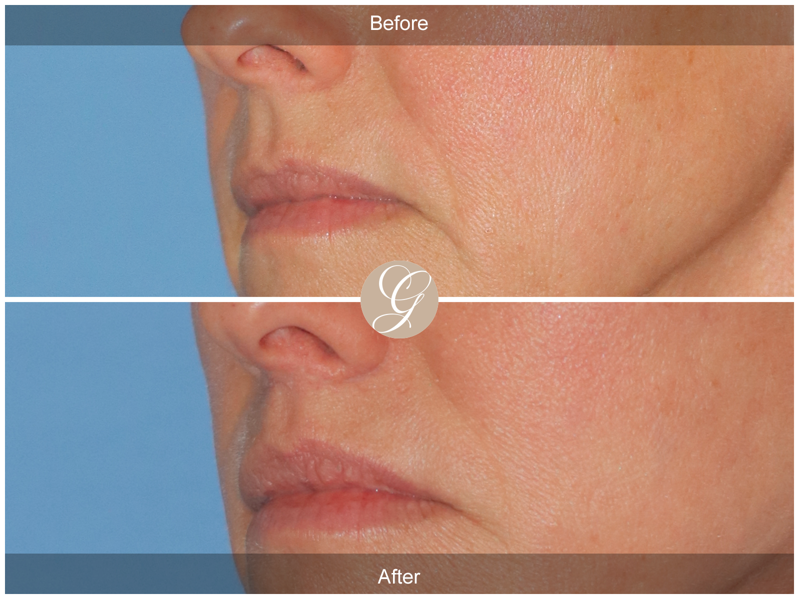 Lip Lift 8744 Image