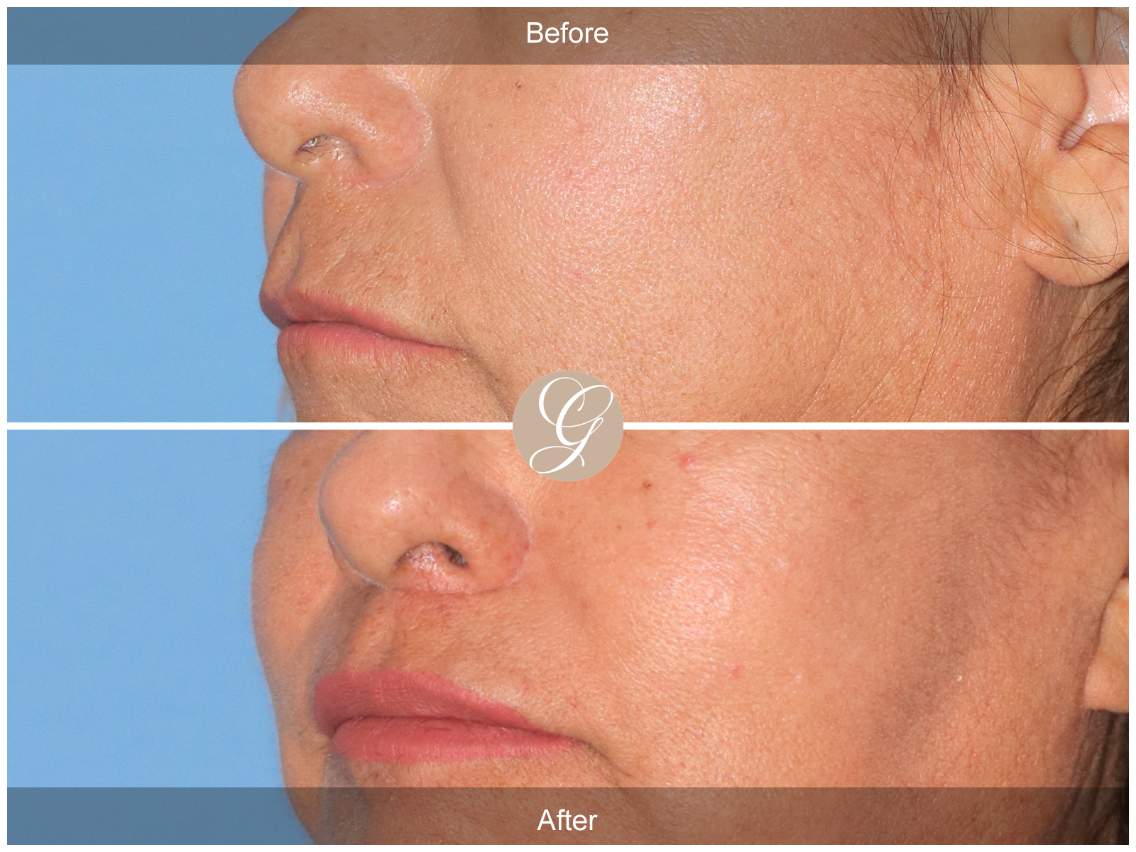 Lip Lift 9045 Image