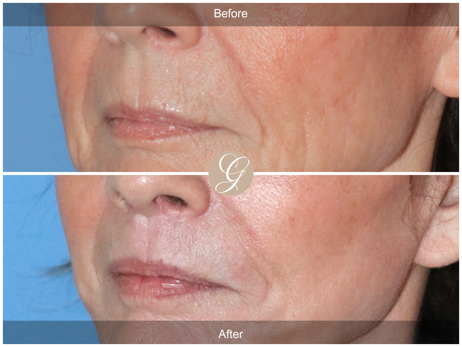 Lip Lift 2201 Image